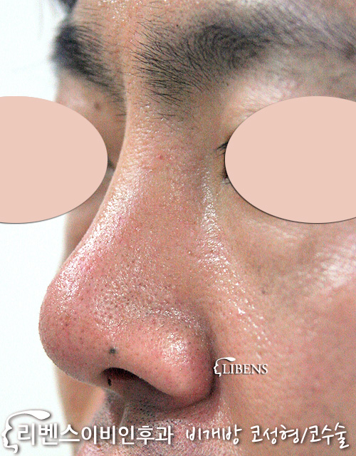 남자 콧대 수술 코끝 복코 높이기 융비술 휜코 비중격 연골 성형 s139